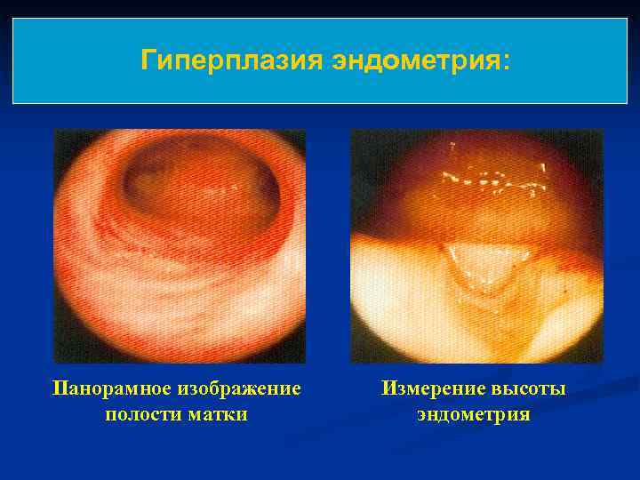   Гиперплазия эндометрия: Панорамное изображение  Измерение высоты полости матки  эндометрия 