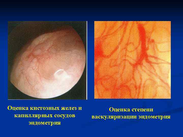 Оценка кистозных желез и   Оценка степени  капиллярных сосудов  васкуляризации эндометрия