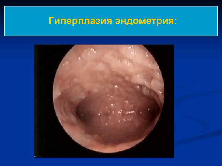 Гиперплазия эндометрия: 