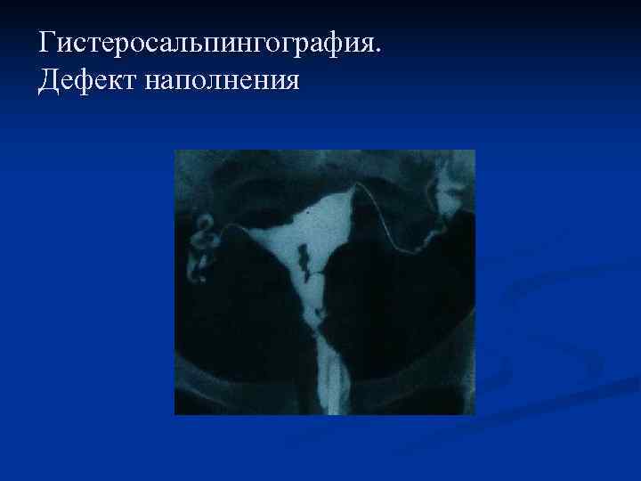 Гистеросальпингография. Дефект наполнения 
