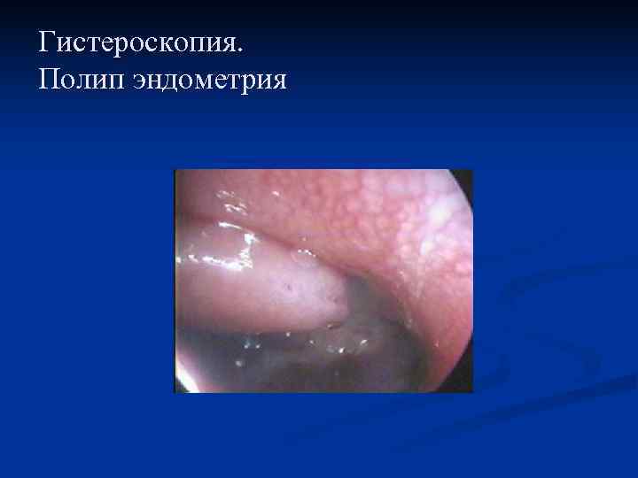 Гистероскопия. Полип эндометрия 