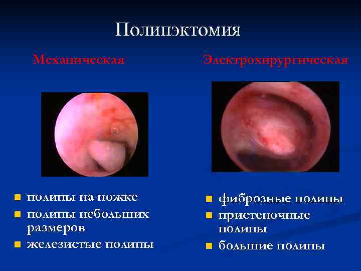     Полипэктомия Механическая  Электрохирургическая n  полипы на ножке n