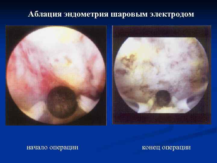 Аблация эндометрия шаровым электродом начало операции   конец операции 