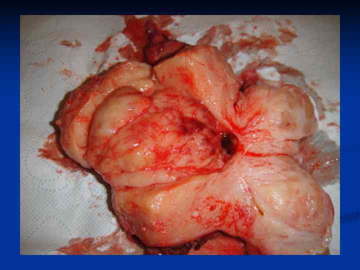 Полип эндометрия 