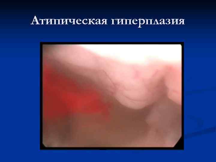 Атипическая гиперплазия 