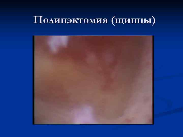Полипэктомия (щипцы) 