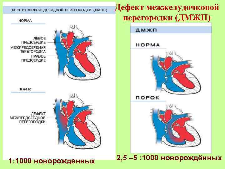 Дефект межжелудочковой перегородки картинки