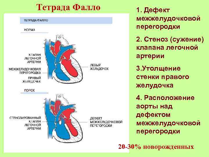 Тетрада фалло гемодинамика схема