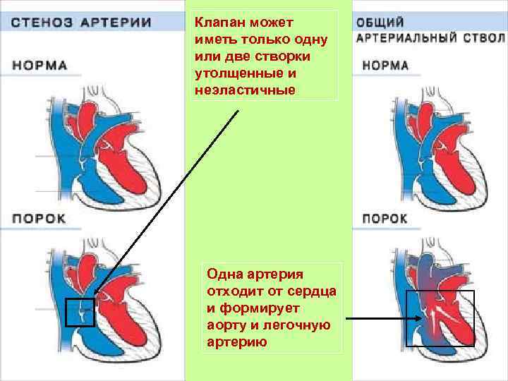 Легочный клапан сколько створок