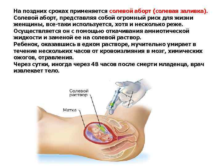 На поздних сроках применяется солевой аборт (солевая заливка). Солевой аборт, представляя собой огромный риск На поздних сроках применяется солевой аборт (солевая заливка). Солевой аборт, представляя собой огромный риск
