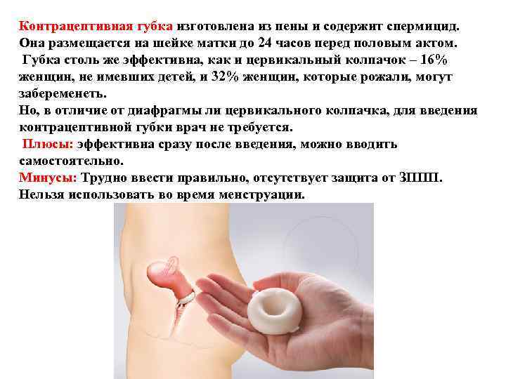 Контрацептивная губка изготовлена из пены и содержит спермицид. Она размещается на шейке матки Контрацептивная губка изготовлена из пены и содержит спермицид. Она размещается на шейке матки