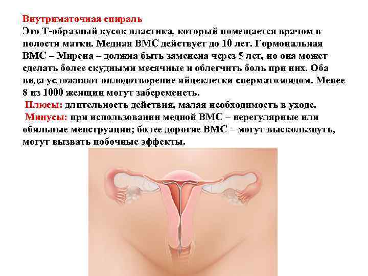 Внутриматочная спираль Это Т-образный кусок пластика, который помещается врачом в полости матки. Медная ВМС Внутриматочная спираль Это Т-образный кусок пластика, который помещается врачом в полости матки. Медная ВМС