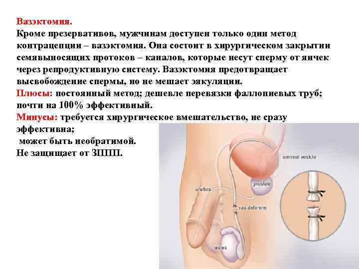 Вазэктомия. Кроме презервативов, мужчинам доступен только один метод контрацепции – вазэктомия. Она состоит Вазэктомия. Кроме презервативов, мужчинам доступен только один метод контрацепции – вазэктомия. Она состоит