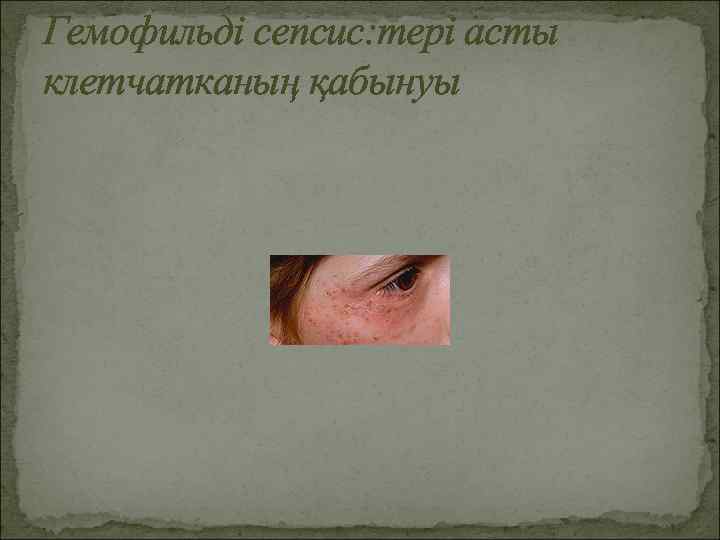 Гемофильді сепсис: тері асты клетчатканың қабынуы 