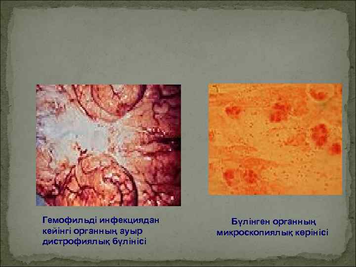 Гемофильді инфекциядан Бүлінген органның кейінгі органның ауыр  микроскопиялық көрінісі дистрофиялық бүлінісі 