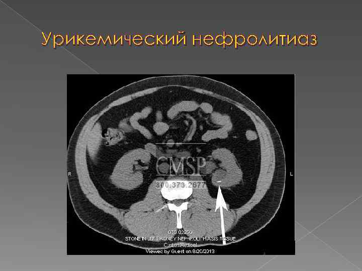 Урикемический нефролитиаз 