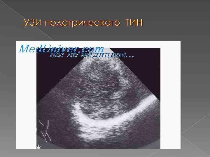 УЗИ подагрического ТИН 