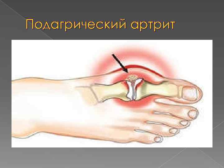 Подагрический артрит 