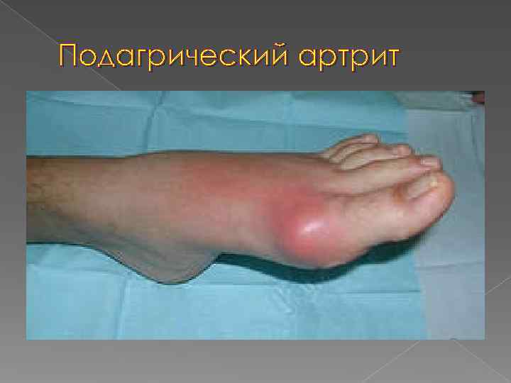 Подагрический артрит 