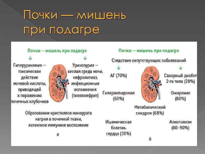 Почки — мишень при подагре 