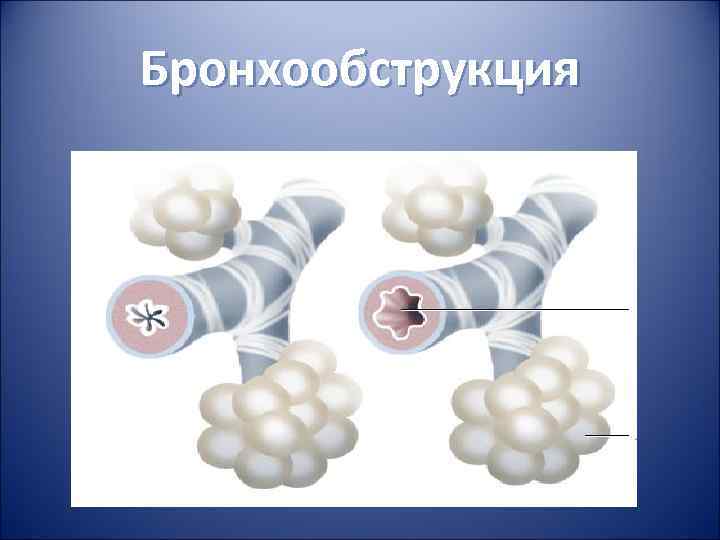 Бронхообструкция Бронхообструкция
