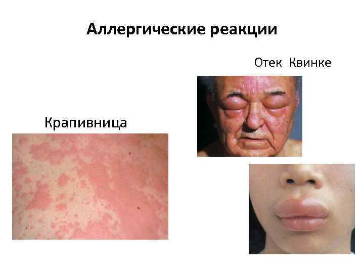    Аллергические реакции       Отек Квинке 
