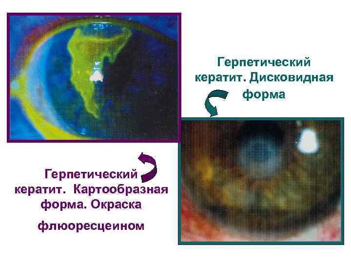       Герпетический     кератит. Дисковидная 
