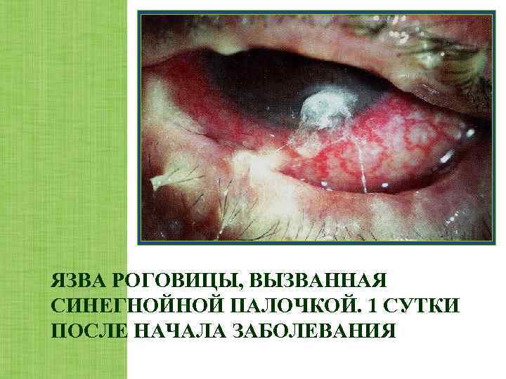 ЯЗВА РОГОВИЦЫ, ВЫЗВАННАЯ СИНЕГНОЙНОЙ ПАЛОЧКОЙ. 1 СУТКИ ПОСЛЕ НАЧАЛА ЗАБОЛЕВАНИЯ 