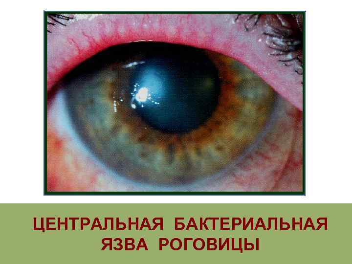 ЦЕНТРАЛЬНАЯ БАКТЕРИАЛЬНАЯ  ЯЗВА РОГОВИЦЫ 