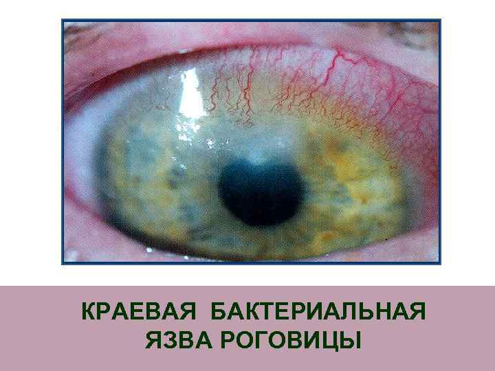 КРАЕВАЯ БАКТЕРИАЛЬНАЯ ЯЗВА РОГОВИЦЫ 