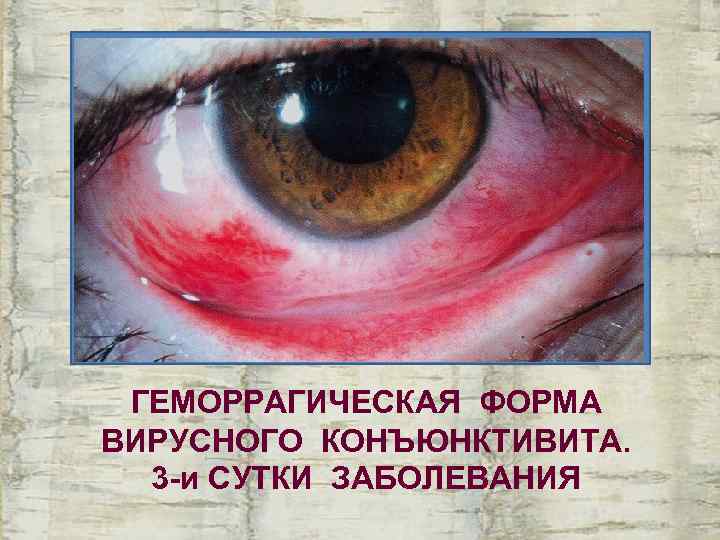  ГЕМОРРАГИЧЕСКАЯ ФОРМА ВИРУСНОГО КОНЪЮНКТИВИТА.  3 -и СУТКИ ЗАБОЛЕВАНИЯ 