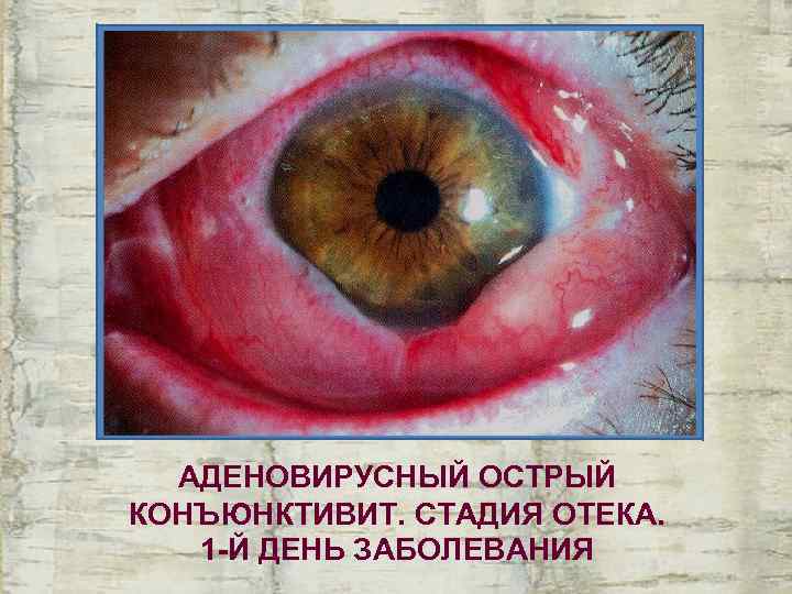  АДЕНОВИРУСНЫЙ ОСТРЫЙ КОНЪЮНКТИВИТ. СТАДИЯ ОТЕКА. 1 -Й ДЕНЬ ЗАБОЛЕВАНИЯ 
