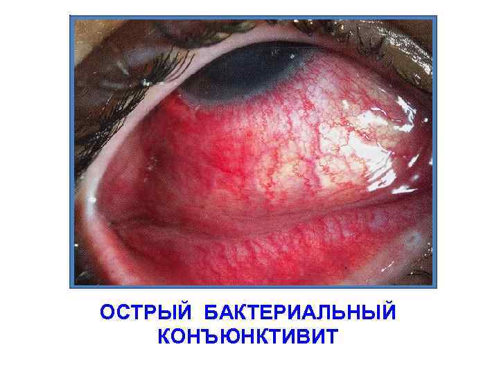 ОСТРЫЙ БАКТЕРИАЛЬНЫЙ КОНЪЮНКТИВИТ 