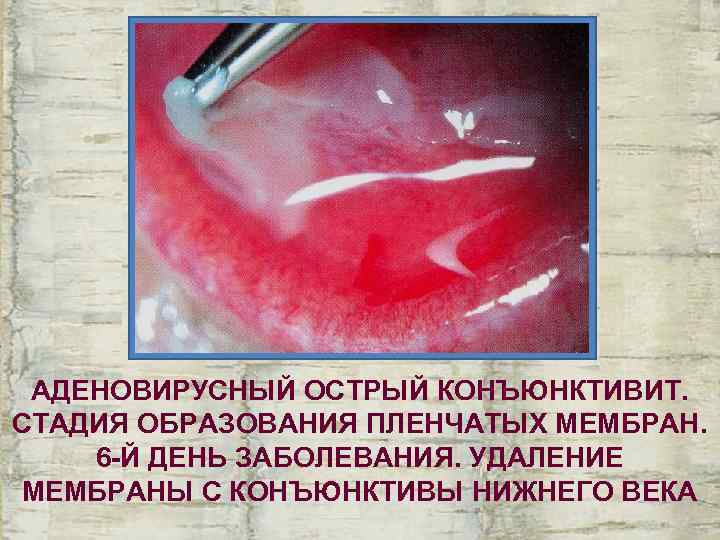  АДЕНОВИРУСНЫЙ ОСТРЫЙ КОНЪЮНКТИВИТ. СТАДИЯ ОБРАЗОВАНИЯ ПЛЕНЧАТЫХ МЕМБРАН. 6 -Й ДЕНЬ ЗАБОЛЕВАНИЯ. УДАЛЕНИЕ МЕМБРАНЫ