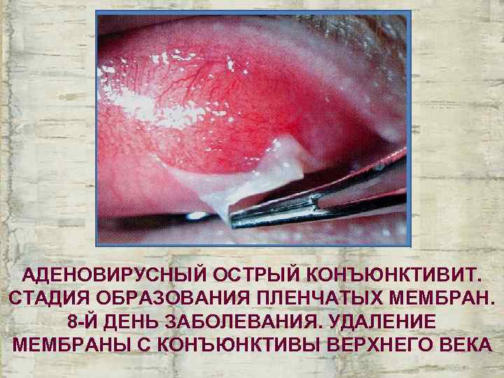  АДЕНОВИРУСНЫЙ ОСТРЫЙ КОНЪЮНКТИВИТ. СТАДИЯ ОБРАЗОВАНИЯ ПЛЕНЧАТЫХ МЕМБРАН. 8 -Й ДЕНЬ ЗАБОЛЕВАНИЯ. УДАЛЕНИЕ МЕМБРАНЫ