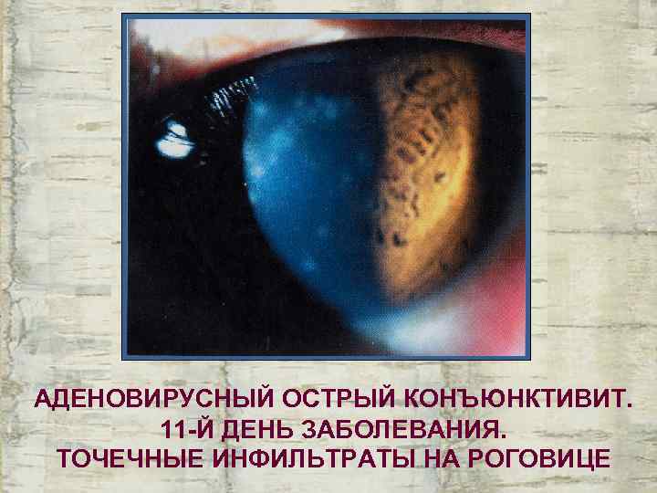 АДЕНОВИРУСНЫЙ ОСТРЫЙ КОНЪЮНКТИВИТ.   11 -Й ДЕНЬ ЗАБОЛЕВАНИЯ.  ТОЧЕЧНЫЕ ИНФИЛЬТРАТЫ НА РОГОВИЦЕ