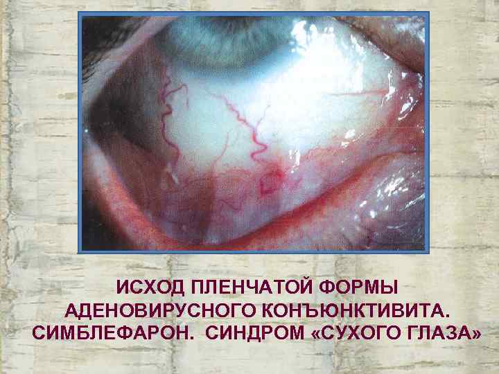  ИСХОД ПЛЕНЧАТОЙ ФОРМЫ  АДЕНОВИРУСНОГО КОНЪЮНКТИВИТА. СИМБЛЕФАРОН. СИНДРОМ «СУХОГО ГЛАЗА» 