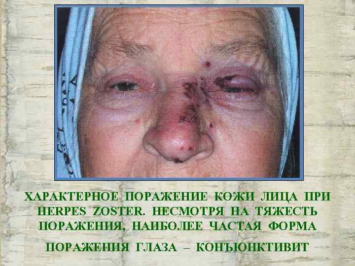 ХАРАКТЕРНОЕ ПОРАЖЕНИЕ КОЖИ ЛИЦА ПРИ HERPES ZOSTER. НЕСМОТРЯ НА ТЯЖЕСТЬ  ПОРАЖЕНИЯ, НАИБОЛЕЕ ЧАСТАЯ