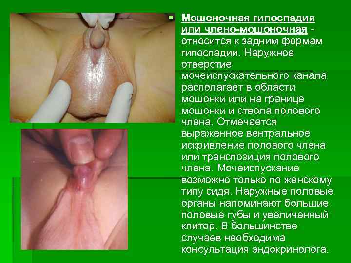 § Мошоночная гипоспадия  или члено-мошоночная -  относится к задним формам  гипоспадии.