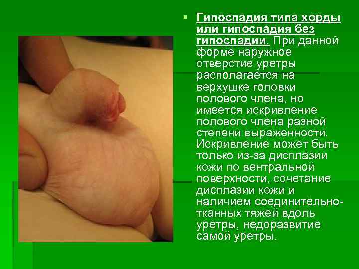§ Гипоспадия типа хорды  или гипоспадия без  гипоспадии. При данной  форме