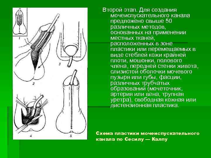  Второй этап. Для создания мочеиспускательного канала предложено свыше 50 различных методов,  основанных