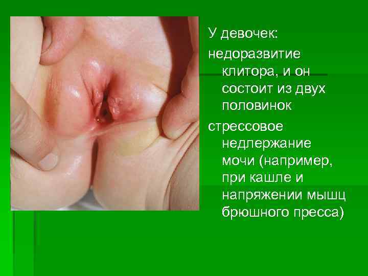 У девочек: недоразвитие  клитора, и он  состоит из двух  половинок стрессовое