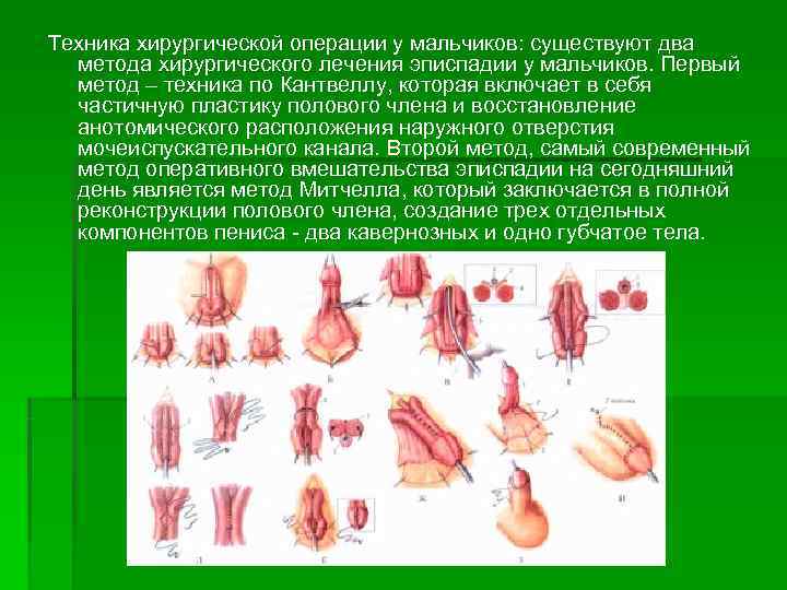 Техника хирургической операции у мальчиков: существуют два  метода хирургического лечения эписпадии у мальчиков.