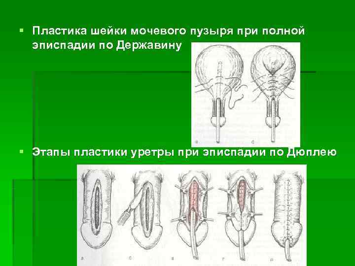 § Пластика шейки мочевого пузыря при полной  эписпадии по Державину § Этапы пластики