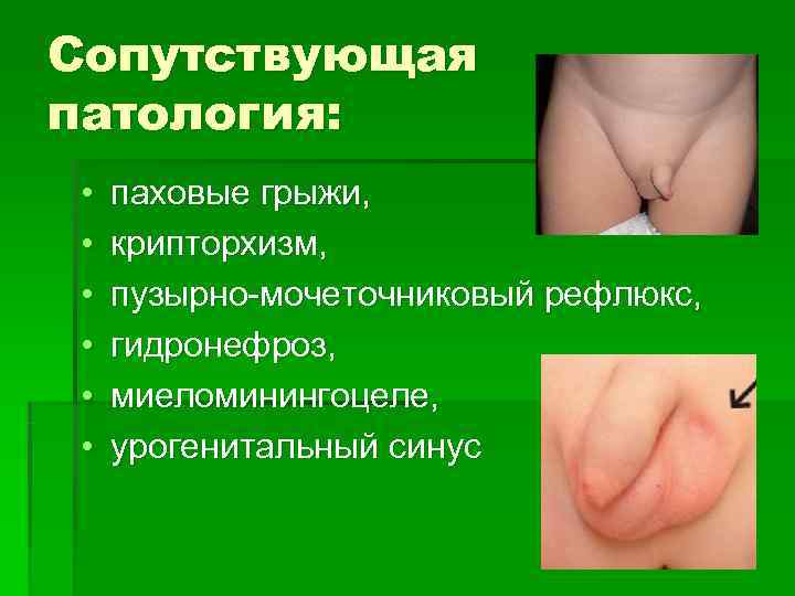 Сопутствующая патология:  •  паховые грыжи,  •  крипторхизм,  • 