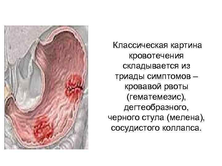   Классическая картина  кровотечения   складывается из  триады симптомов –