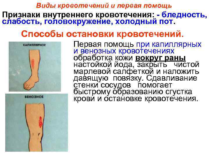   Виды кровотечений и первая помощь Признаки внутреннего кровотечения: - бледность, слабость, головокружение,