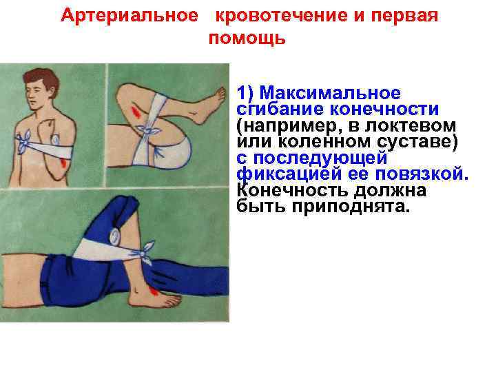 Артериальное кровотечение и первая   помощь   1) Максимальное   