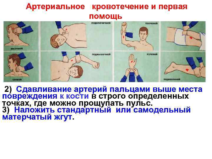  Артериальное кровотечение и первая    помощь 2) Сдавливание артерий пальцами выше