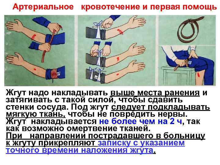  Артериальное кровотечение и первая помощь Жгут надо накладывать выше места ранения и затягивать
